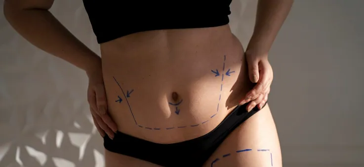 What is Rib Removal?