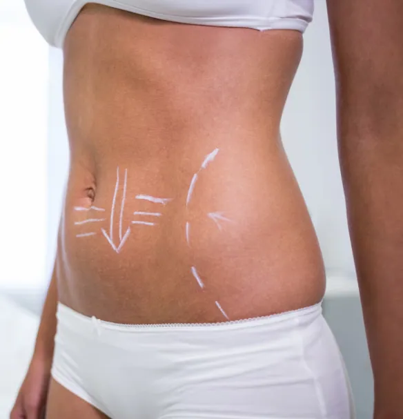 tummy-tuck