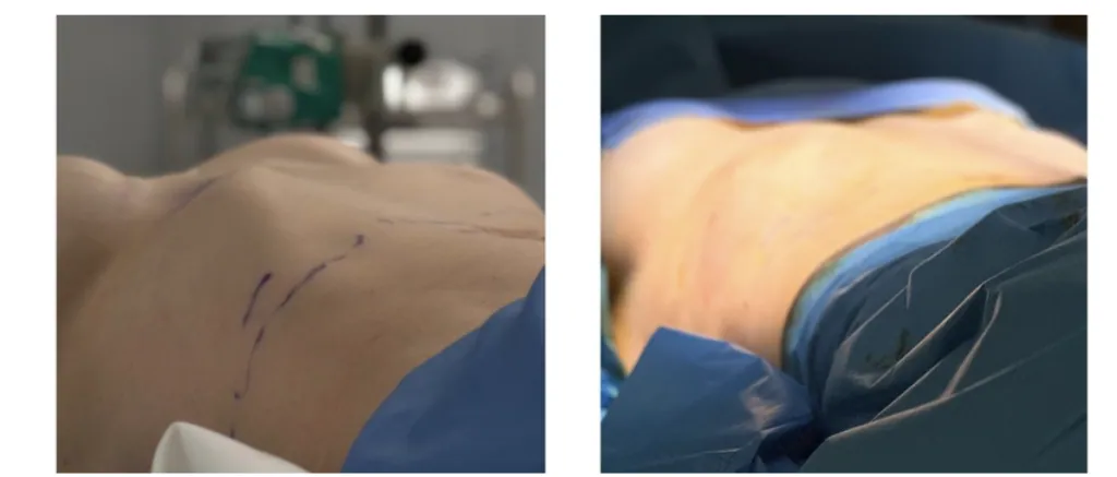 Scarless Rib Remodeling Ribella Technique : Neden Göğüs Cerrahı?